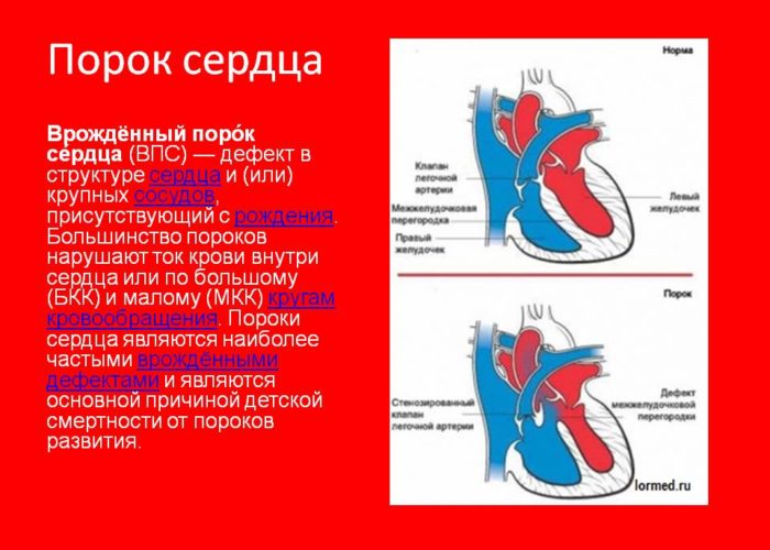 Порок сердца