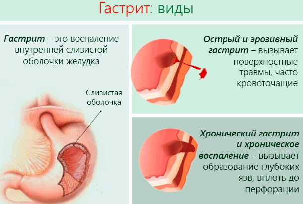 Гастрит
