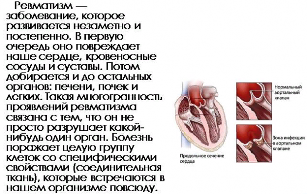 Ревматизм